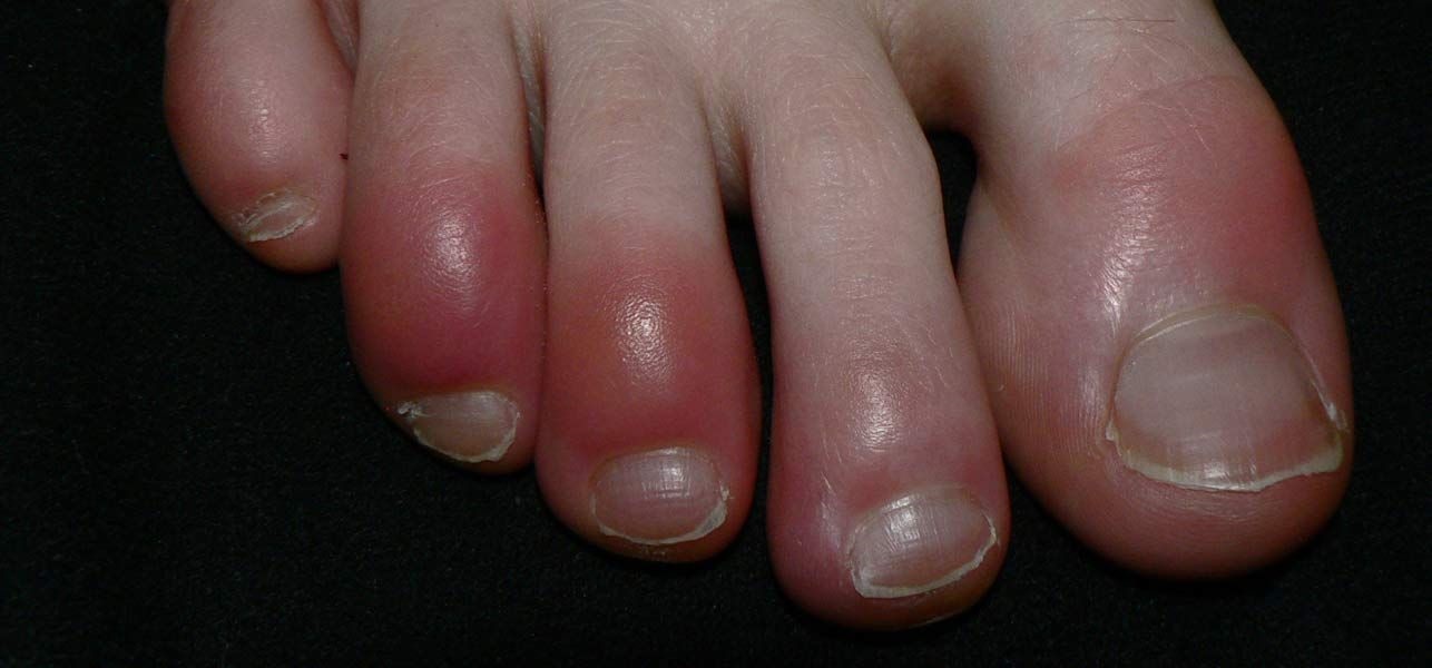 Chilblains Symptoms and causes