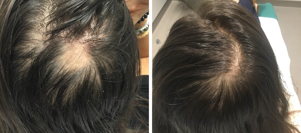  treatment for hair growth after and before 