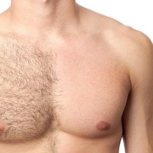 Permanent hair removal for men 