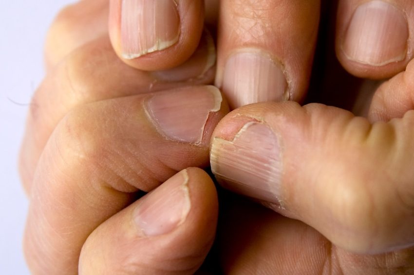 What Causes Brittle Nails