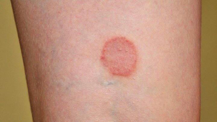 Ringworm Rashes causes and solutions