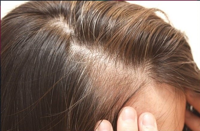 Thinning hair treatment