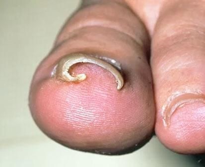 Ingrown Toenail Home Treatments