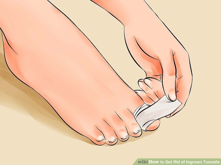 Ingrown Toenail Home Treatments