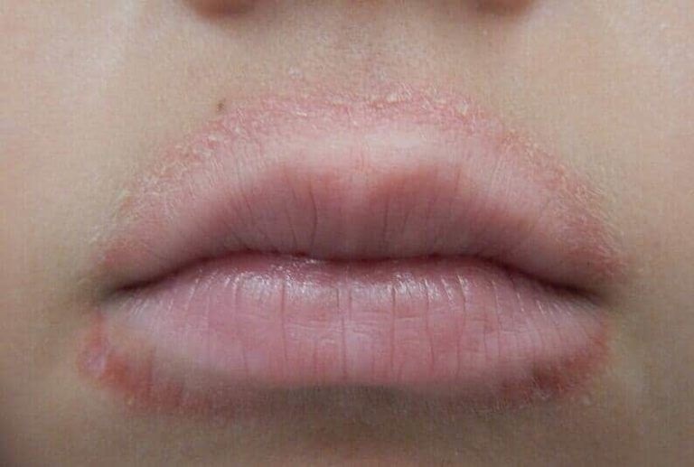 Lips Infection Treatment