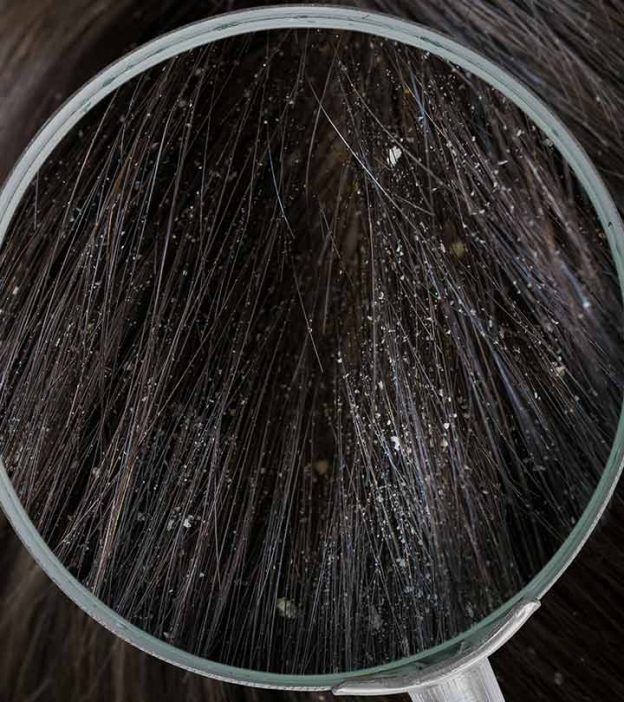 Dandruff causes and treatments