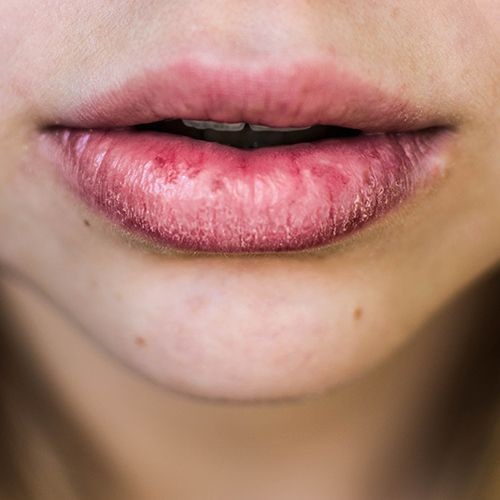 Lips Infection Treatment