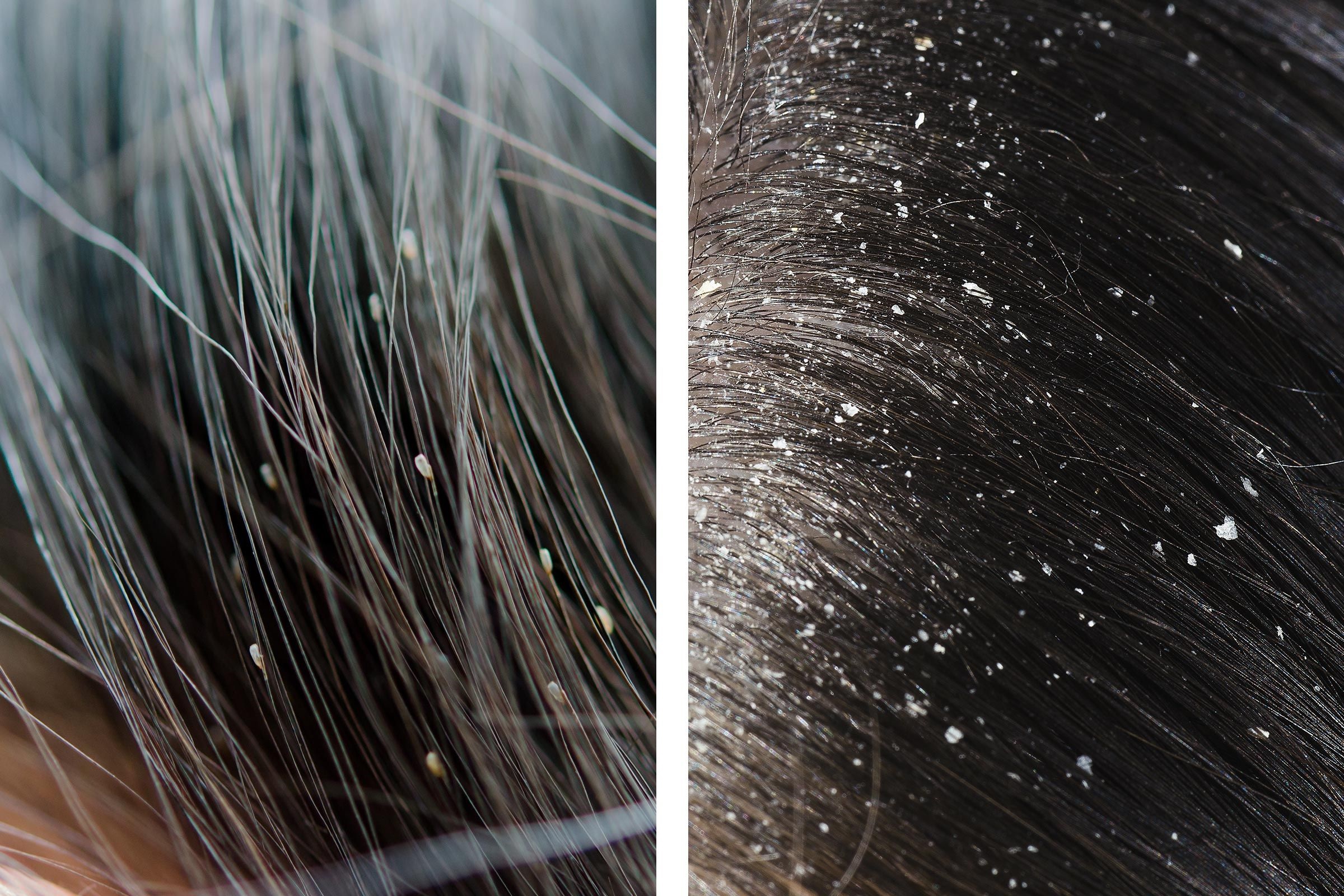 difference between dandruff and lice in your hairs
