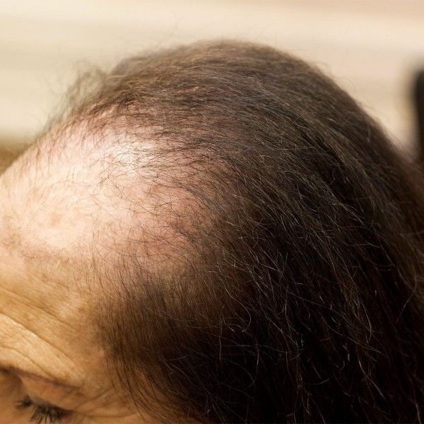 Thinning hair treatment