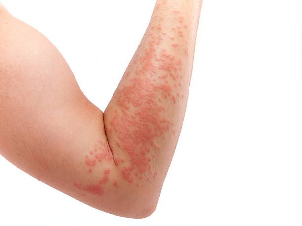 Arm covered in a skin allergy, hives