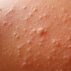 skin rash 