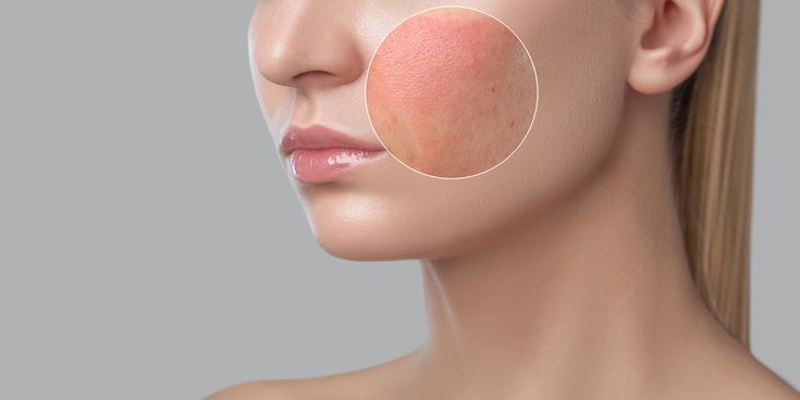 Chemical Irritants allergy on skin 